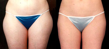 Liposuction in Newport Beach, Los Angeles, Southern California