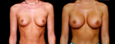 Breast Enlargement Los Angeles, Newport Beach, Orange County, San Diego