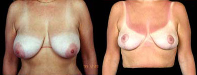 Breast Enhancement in Orange County and Los Angeles